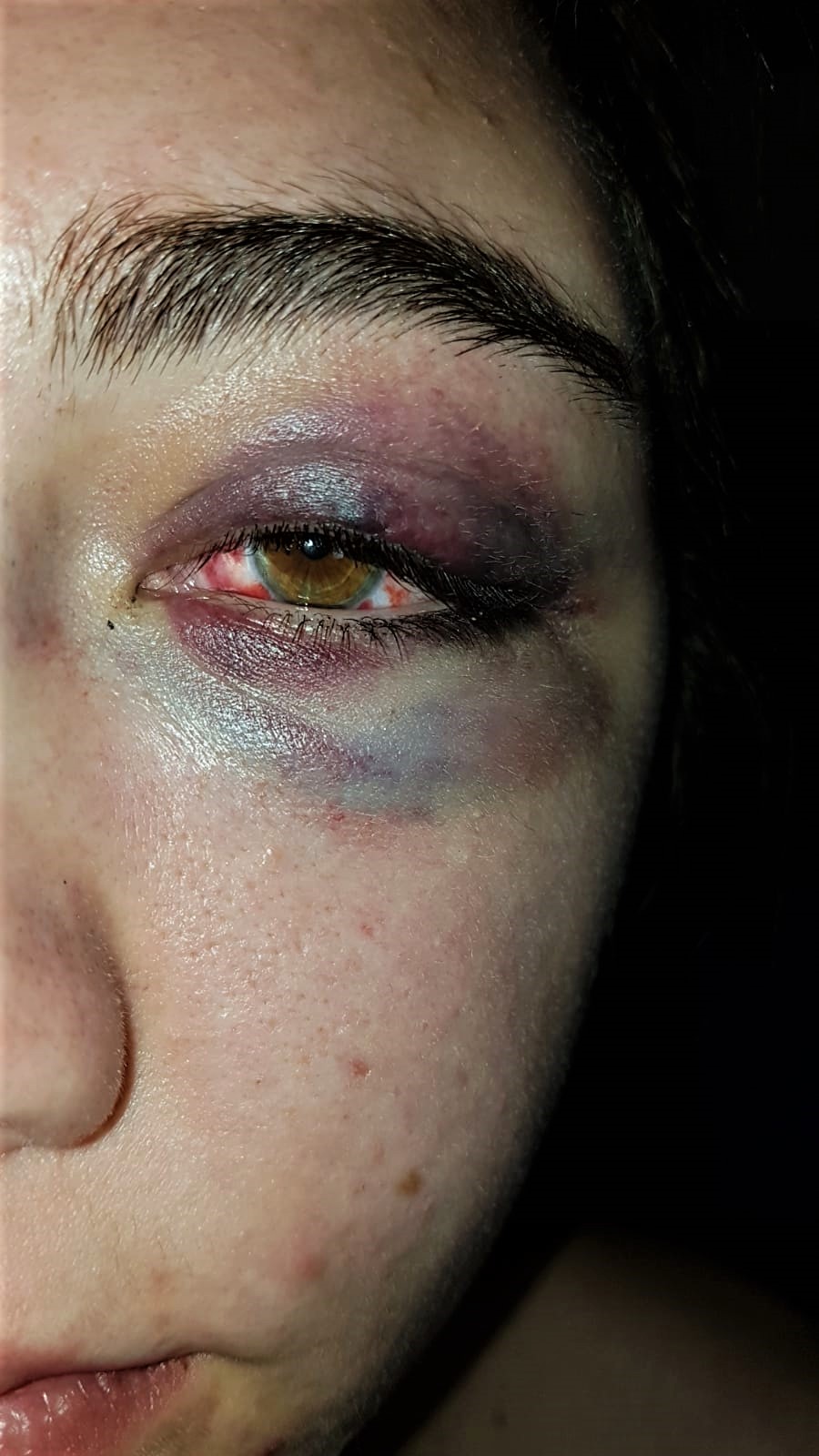 Hämatom am linken Auge von Kim B. (Quelle: Kim B.)